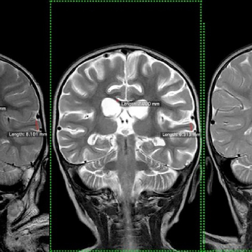 Changing the landscape of emergency medicine & crisis response-*Millions of people, including emergency responders and military personnel, are at risk from traumatic brain injury, which can have devastating and enduring consequences. Our R&D team reports on promising medical developments for such injuries, calling for further research into its potential for other conditions